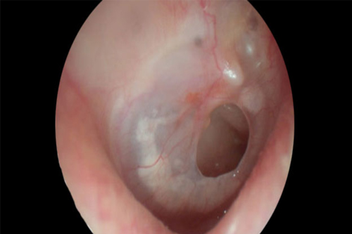 Ear Drum Perforation