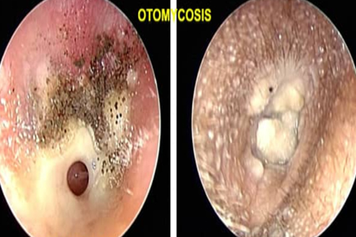 Fungus-Otomycosis