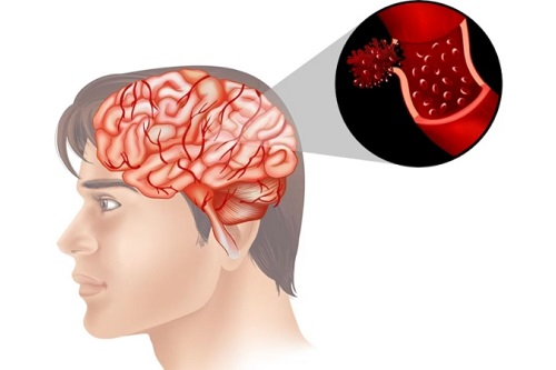 Stroke & Paralysis in details neuro clottings show