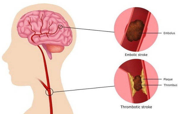 stroke thrombolysis