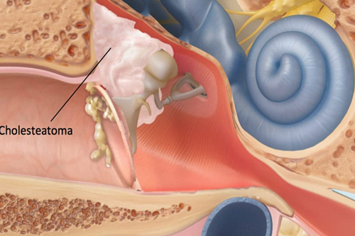 cholesteatoma